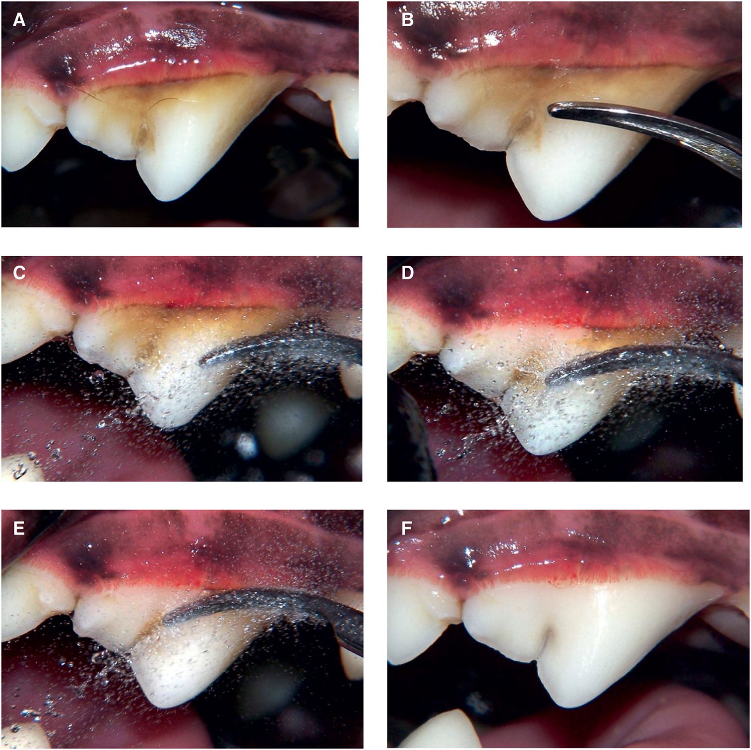 Images of Sequence for a dental cleaning using an ultrasonic scaler