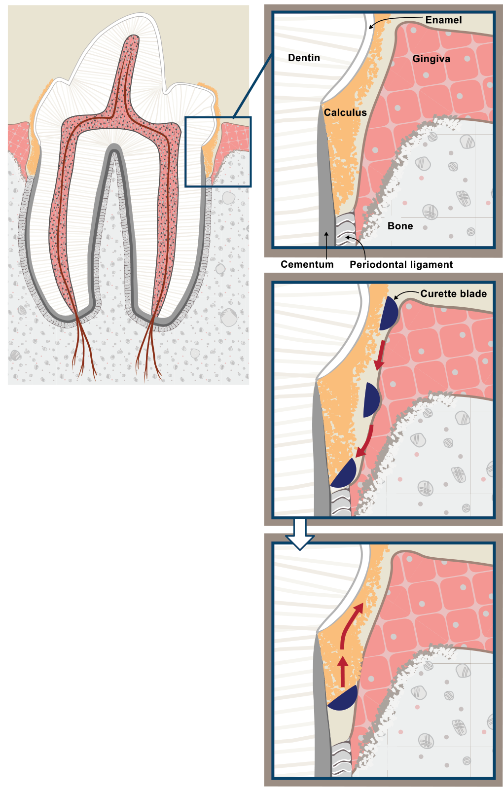 Diagram of Subgingival curettage