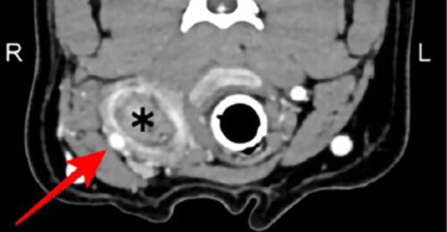 CT scan of a dog that shows a cervical abscess caused by a wooden stick, causing sialadenosis—enlarged salivary glands.