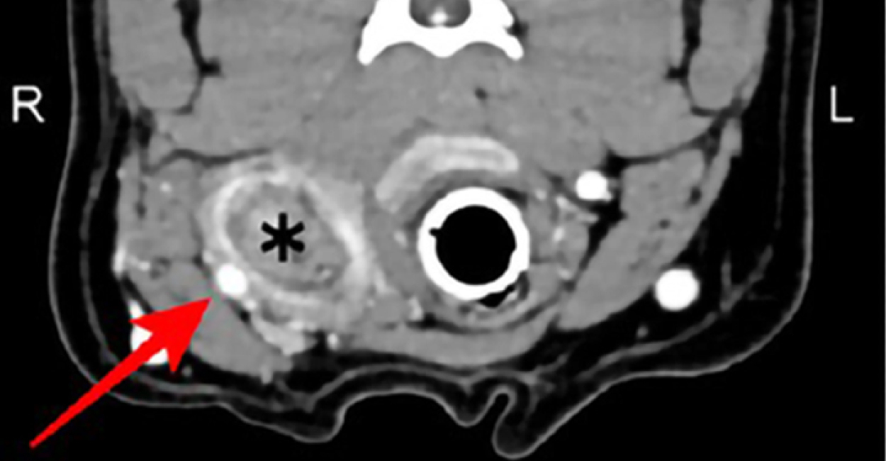 CT scan of a dog that shows a cervical abscess caused by a wooden stick, causing sialadenosis—enlarged salivary glands.