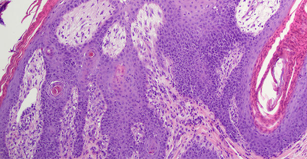JAAHA Abstract: Superficial Necrolytic Dermatitis with Copper Chelation in a Dog with Copper-Associated Hepatitis