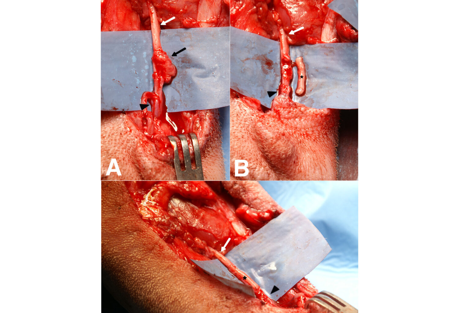 Photos taken during surgery on a tibial nerve neuroma.