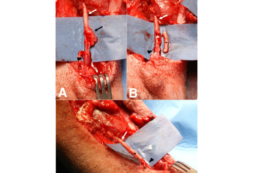 Photos taken during surgery on a tibial nerve neuroma.