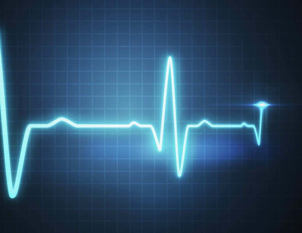 EKG graph illustration